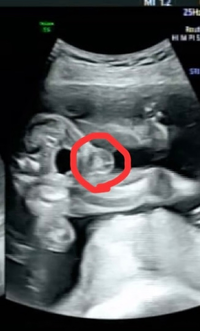 現在 妊娠6ヶ月 21週 です 睾丸に見えますが 性別は男の子でしょうか Yahoo 知恵袋