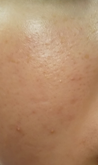 助けてください 肌が綺麗になりません ニキビはほとんどなくなったの Yahoo 知恵袋