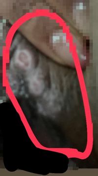 お見苦しい写真失礼します 尖圭コンジローマと診断され 電気メス Yahoo 知恵袋