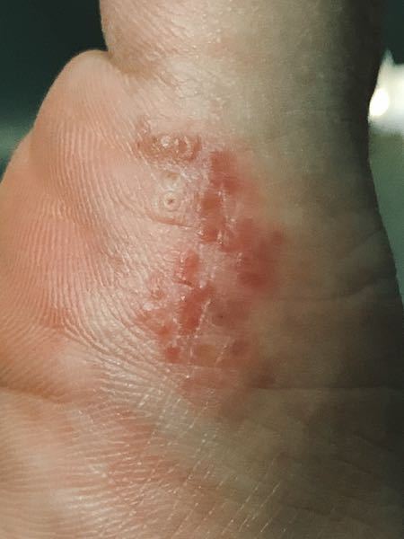 足の親指の付け根の側面に 写真のような湿疹(？ ができて2週間 現状、痛くも痒くもなく(あえて押すと通常な部位と比較して若干痛みを感じる程度 広がりもせず収まりもせずで様子見てるのですが こ...