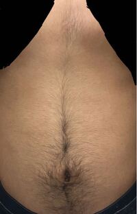 画像あり高校一年生男子です 毛深くて悩んでいます 特にギャラン Yahoo 知恵袋