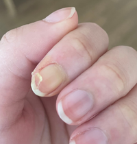 写真グロかったらすみません 昨日料理をしていたら包丁で爪の真ん Yahoo 知恵袋