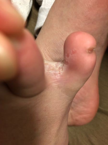 右足の小指と薬指の間の画像です これは 水虫ですか も Yahoo 知恵袋