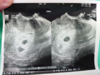 5週6日のエコー写真なんですが 胎嚢の大きさって1 61 Yahoo 知恵袋