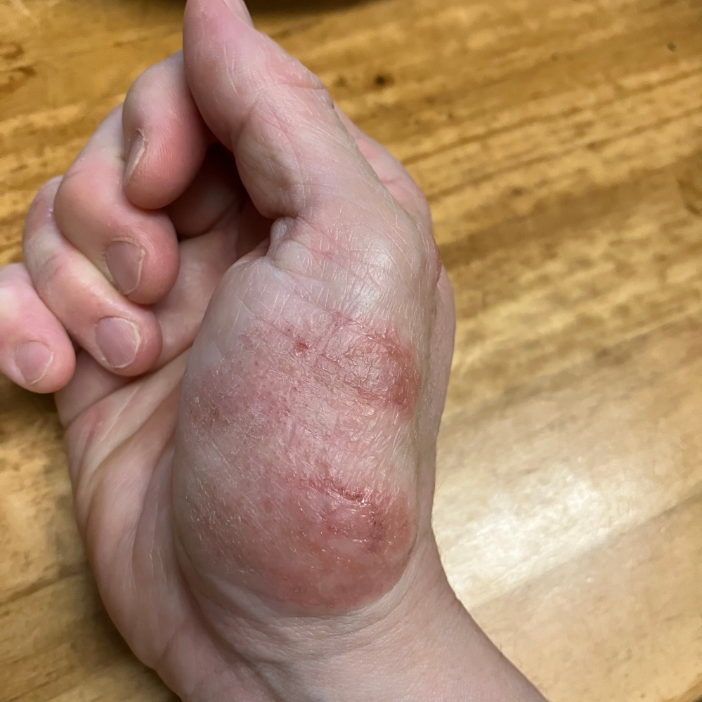 これはアトピー性皮膚炎でしょうか？ 右手のみ症状があります。 ジュクジュクした部分と乾燥した部分があります。
