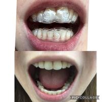 インビザラインの保定装置や後戻りについて教えてください 矯正し Yahoo 知恵袋