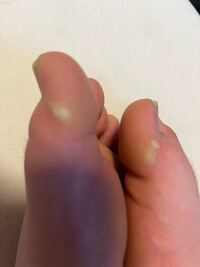 写真の 足指の横にできている白いものはタコでしょうか 詳しい方 Yahoo 知恵袋