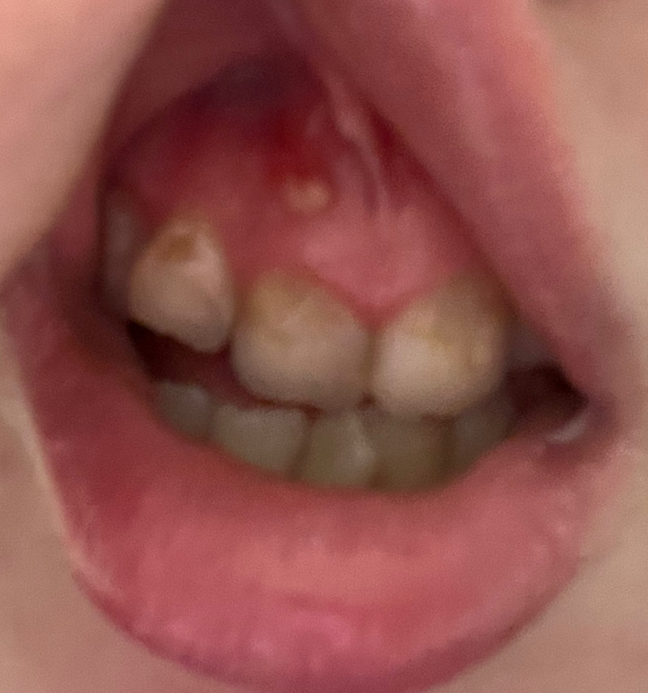 歯茎にあるできものなんでしょうか 口内炎でしょうか 1年半以上治りません Yahoo 知恵袋