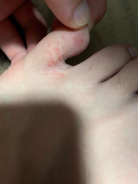 21歳男です。これって水虫ですか？最近爪を切ってる時に気付きました。 水虫の場合、どうしたら治りますか？