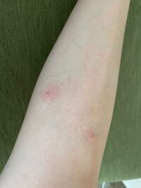 至急 これはダニさされですか 痒みはなく 赤みのみ引きません 触ると硬いしこり Yahoo 知恵袋