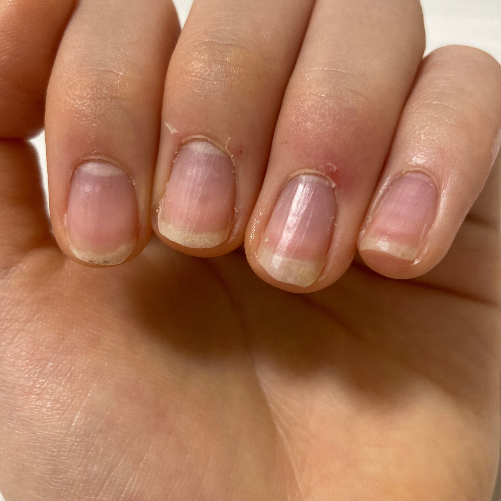 最近甘皮処理をセルフでしているのですが質問があります これ私の爪なんです Yahoo 知恵袋