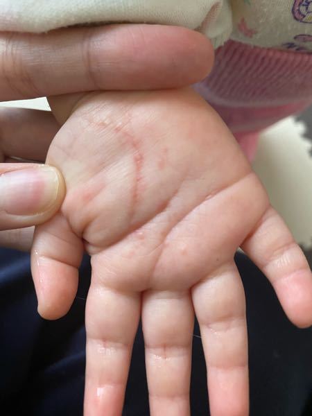 子どもの病気とトラブル 投票受付中の質問 Yahoo 知恵袋