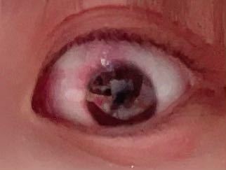 閲覧注意 最近黒目の横がこのように充血します。 コンタクトをつけると違和感がありすぐ外したくなります。今まで同じコンタクトを使用していたのですがこのように充血したのは初めてです。原因はスマホの...