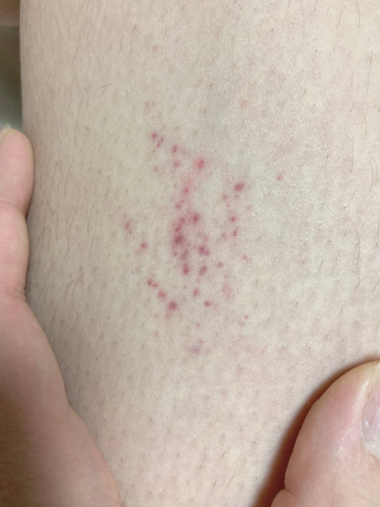 家から帰ってきたら、太ももの内側にこんな発疹ができてました。痛みも痒みもないのですが、ほっといても大丈夫でしょうか？