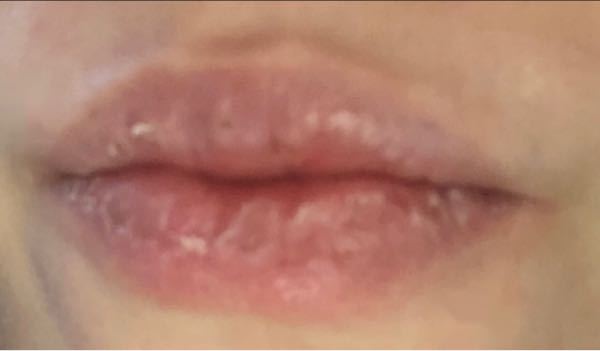 唇の乾燥が酷いです。原因は分からないですがどうすればぷるぷるになれますか？ 唇以外も乾燥肌ですが、唇は特にひどいです。 子供の頃からでした。。。 リップクリームを塗ってもすぐに乾くし、 冬とか夏とか関係なく年中この状態です。 メンソレータム系のリップクリーム、モアリップやワセリンも試しました。 唇パックなどしたあとは1時間くらいならもちます。 唇を舐めたり皮をむいたりとかのダメな習慣があるわけでもないです。 口紅を塗れないのが悲しいです。どうにか改善したいので、何かご存知の方は教えてください、、、！ 呼吸は鼻呼吸です。