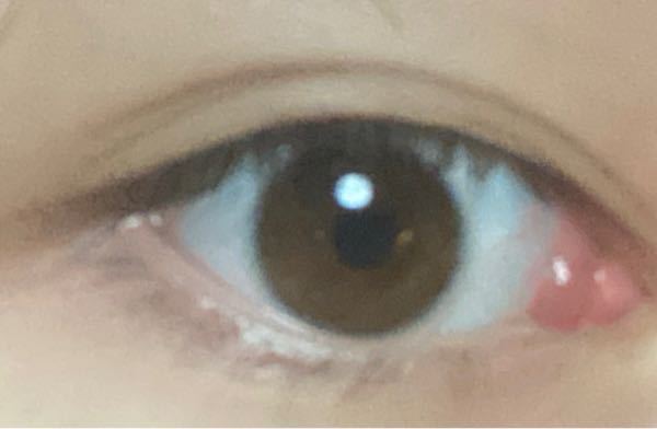 【急募】目頭が腫れていて痒くて痛く、重いのですがどのような病気でしょうか 普段はほぼ無彩色なのですが、写真のようになっています。