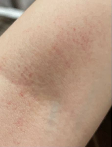 この腕の関節の赤い点々はなぜできるのですか？ 特に痒くもないです。