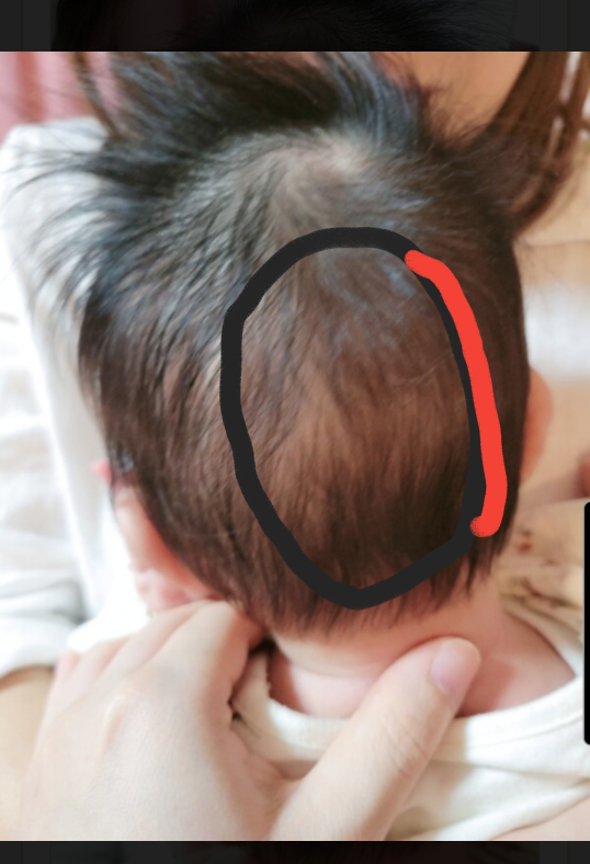 赤ちゃんの頭の骨。 後頭部の骨の左側は気になるほどでもないのですが 右側だけ段差がボコんとあります。 写真の赤い線の所です。 来月の半ばに健診があるので その時に見てもらうでも大丈夫でしょうか？