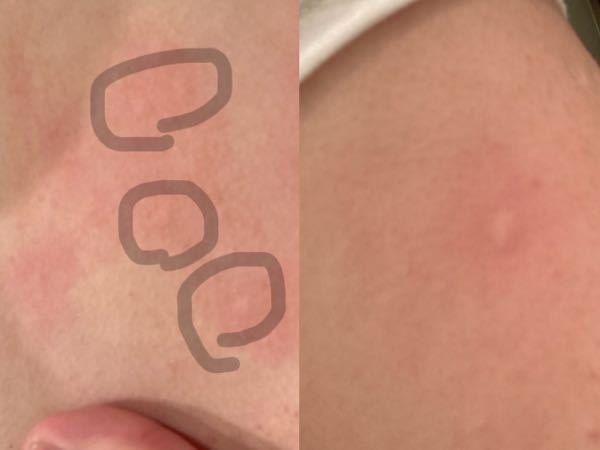 皮膚の症状に詳しい方 至急でお願いします 写真のような斑点が肩〜腕、胸の辺りや背中にでき、痒いです。 蚊に刺された跡より小さい物がポツポツできています これは蕁麻疹の1種でしょうか？ それと...