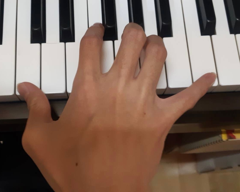 ピアノをしているのですが、オクターブ弾きが右手だけ妙に外れるなと長らく思っていたら親指の第1関節がおかしい形をしていることに気が付きました、 関節の間に力が入る感じで、膨らんで見える部分が痛くな...