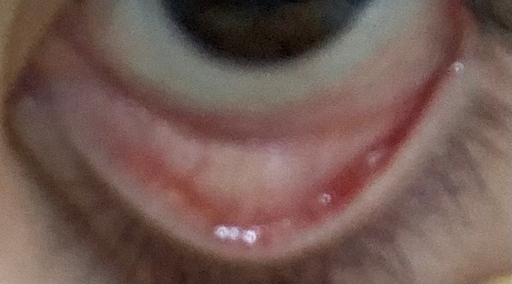 病院で先生に、貧血の症例として写真を撮ってもいいかと言われたので撮りました。 でも、私の下瞼には赤い線が入っています。写真を見てください。 なんでこれで貧血なんですか？ わかる人いますか？