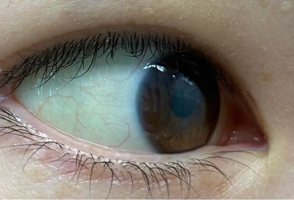 黄疸について質問です。 白目が少し黄色いかなと思ったのですが、病院に行くか行かないか迷っているので回答いただければと思います。 この目は黄疸でしょうか？