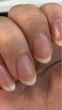 右手薬指に白点があります 0 5ミリほどですが これは幸 Yahoo 知恵袋