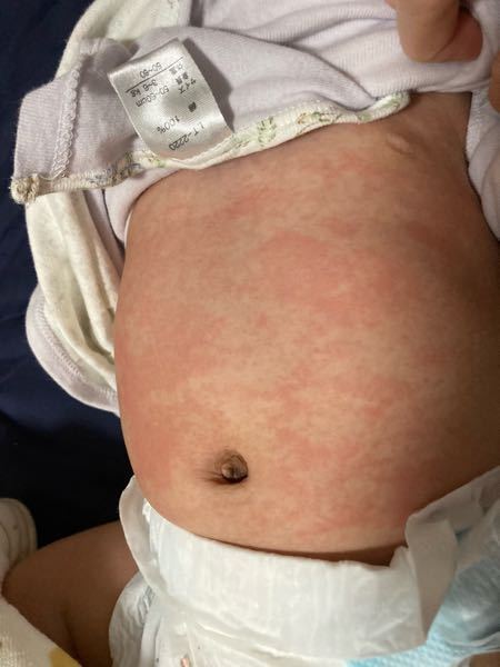 子どもの病気とトラブル 解決済みの質問 Yahoo 知恵袋