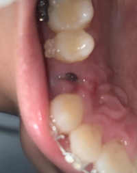 矯正抜歯後3日目です 上の歯 4本目左右抜歯したのですが右側だ Yahoo 知恵袋