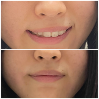 口が左右非対称のせいで笑顔がぎこちなく見えてコンプレックスなのが写真を撮 Yahoo 知恵袋