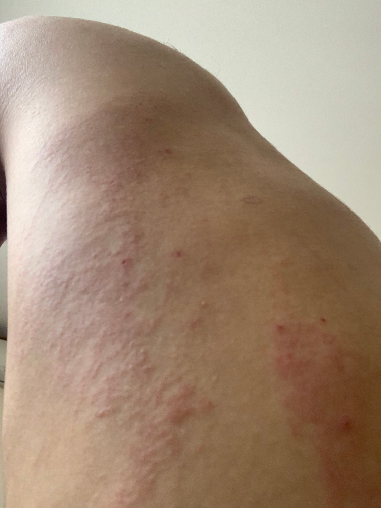 腕や背中に赤茶色のブツブツしたものがでてるのですが性病でしょう Yahoo 知恵袋