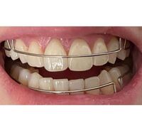 矯正後戻りどこを治したら綺麗になりますか 完璧な歯並びに Yahoo 知恵袋