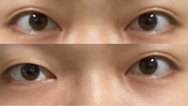 上と下の目はどっちのほうがマシだと思いますか？ 上の目は合成で左右対称にしました。 二重整形をするか前から悩んでいます。