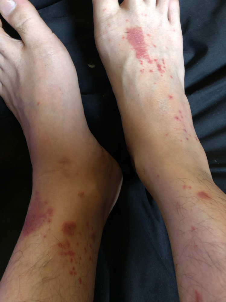 最近足にこんなタダレ？が起きてます。 蚊に刺された箇所もありますが、蚊にしては今までこんな経験した事ないのでアレルギー？とも思いましたが初めてなったので違うのかと思いました。 詳しい方回答お願い...