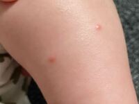 この赤いポツポツはなんでしょうか 生後3ヶ月の息子の肌に Yahoo 知恵袋