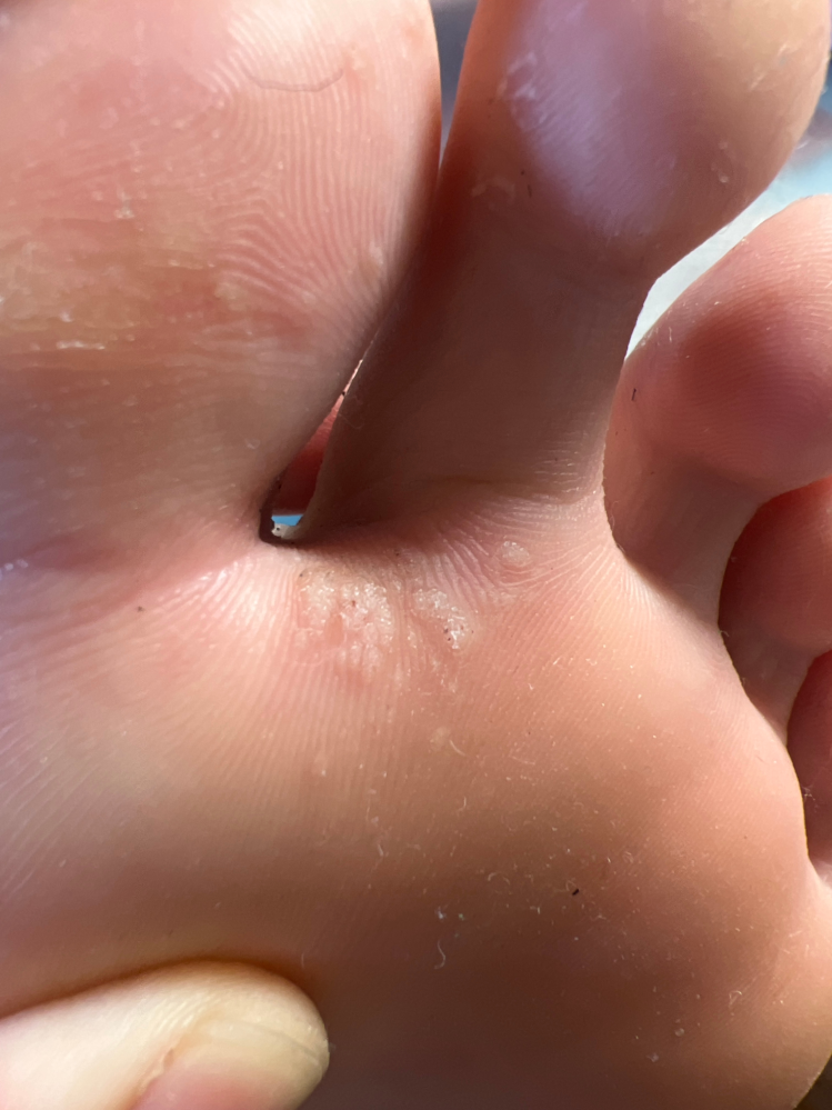最近出来てしまったのですが、この指の間のやつって水虫ですかね、、？ 触ると少し痛む程度で痒みはないです！ 汚い写真ですみません
