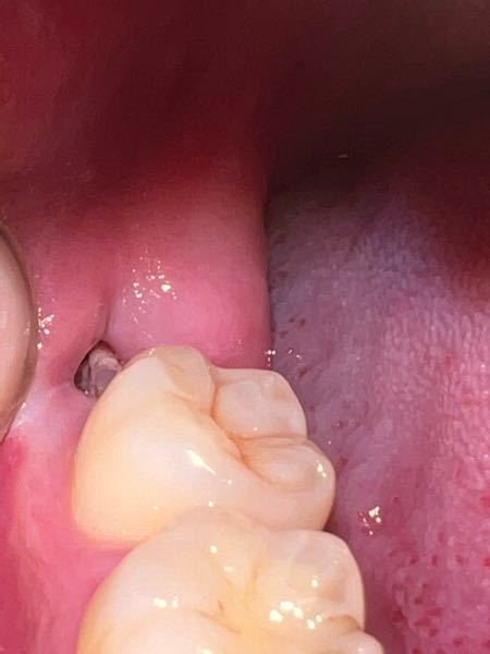 親知らず抜歯後（10日経過）違和感があり、鏡で確認したところ、抜歯した歯茎の奥に白いものがありました。これはなんでしょうか？よろしくお願い致します。