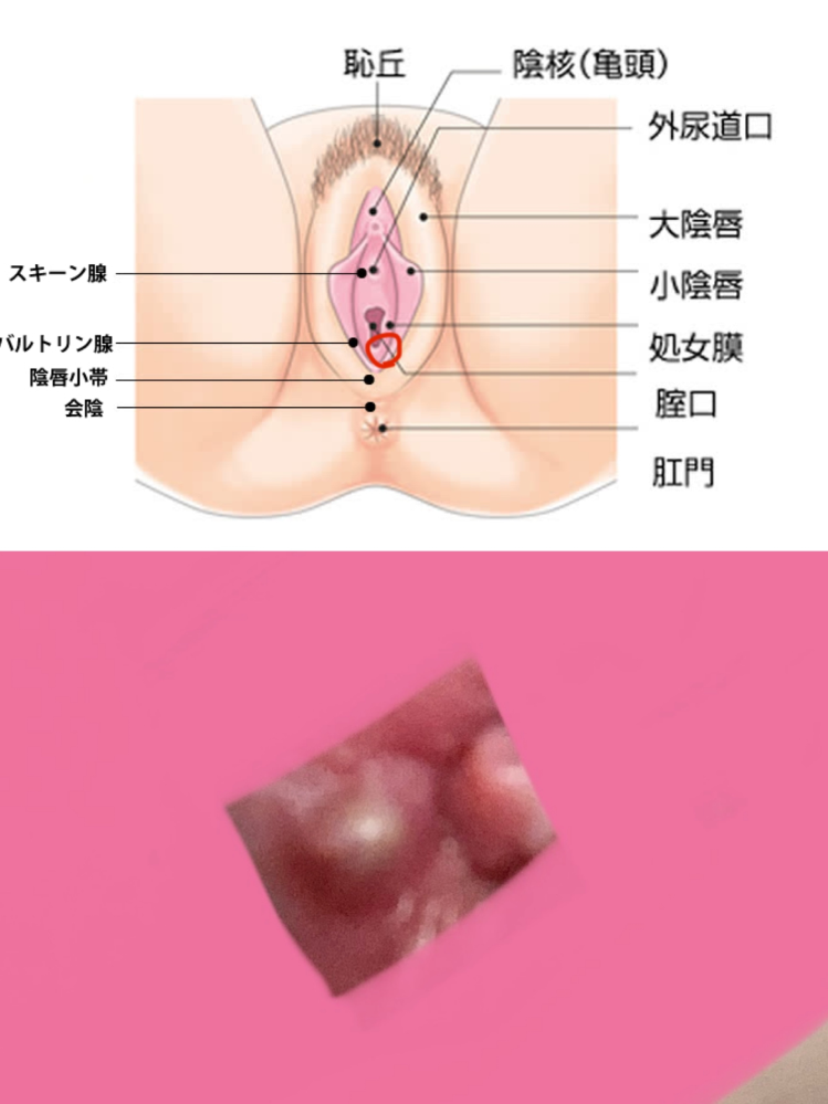 閲覧注意 汚い写真ですみません 画像のようなびらびらをめくった粘膜のよ Yahoo 知恵袋