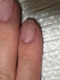 この爪は爪甲剥離でしょうか Yahoo 知恵袋