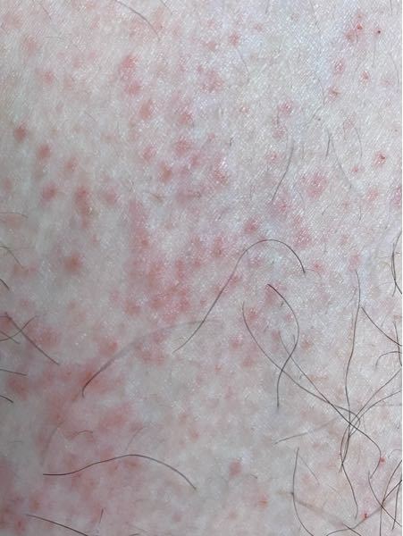 これってダニかぶれですか 汗疹だと思います Yahoo 知恵袋