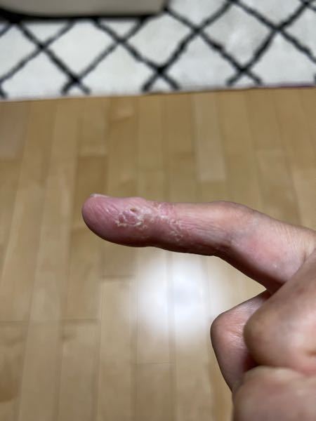 数ヶ月前に小さな水疱ができ、その後潰れたと思ったら痛痒くなりその後、このような皮めくれになりました。初めよりは範囲も広がってます。ひどい時は少しですが腫れもあります。今でも痒く指を曲げると皮膚が...