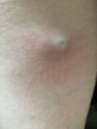 4年前から足の付け根付近に青いこぶのようなものがあります たま Yahoo 知恵袋