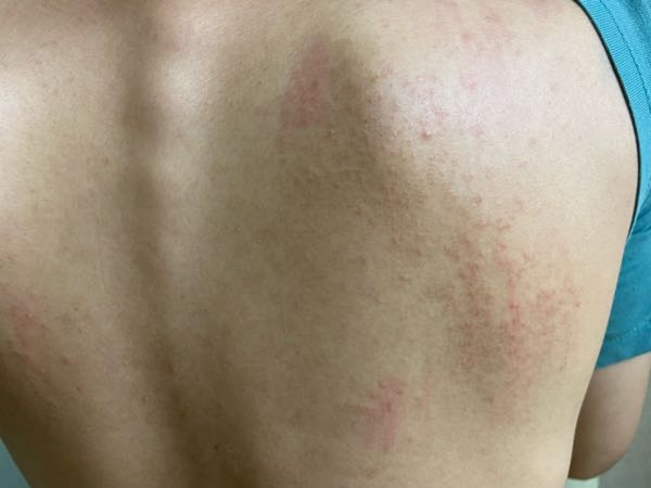 皮膚の病気 アトピー 解決済みの質問 Yahoo 知恵袋