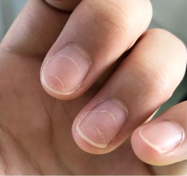 手の爪の表面が画像のように線というか傷が入っていてずっと治りません。これを治すにはどうすればいいのでしょうか？