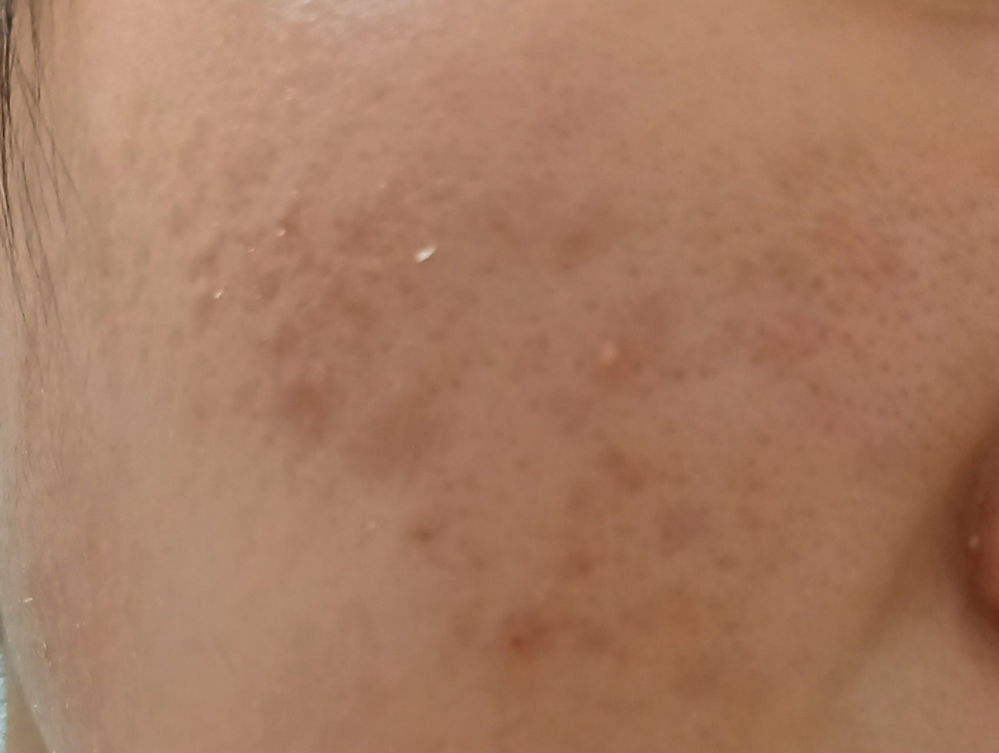 このニキビ跡の治し方を教えてください。 乾燥性敏感肌です。