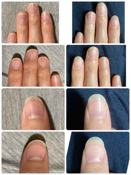 【写真あり】ハイポニキウムを伸ばし始めて約4ヶ月です。この4ヶ月で私がやった事は、 ・爪の白い部分は2〜3ミリでキープ ・爪切りを辞め、爪やすりを使用。 ・指先をあまり駆使しない。 です。これからもっときれいに伸ばしていくためには、どうしたらいいですか？