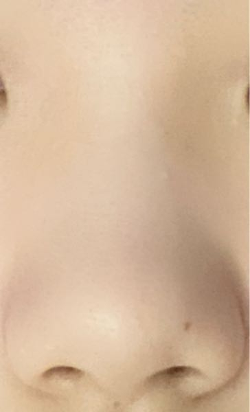 団子鼻と豚鼻とぺちゃ鼻のミックスみたいな人類で1番醜い鼻を持ってるのですが鼻尖形成とプロテーゼでこの鼻は綺麗になりますか…？