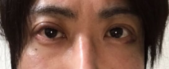眼瞼下垂の手術をしたのですが、この右目のハム目はしばらくすると治り、綺麗な目になりますか？