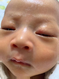 新生児です 目の上の赤い部分は引っ掻き傷ですしょうか それともあ Yahoo 知恵袋