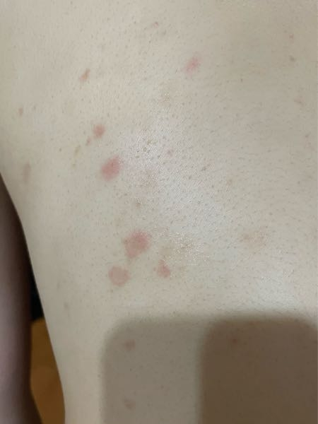 皮膚の疾患に詳しい方、皮膚科の方、皮膚に詳しい方に質問です。 背中にこのような湿疹？ニキビ？ができているのですが何かわかりますか？汗をかくとピリピリします。背中一面、肩などにできています。 皮膚...